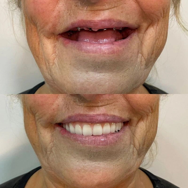 Comparação do sorriso antes e depois da prótese protocolo